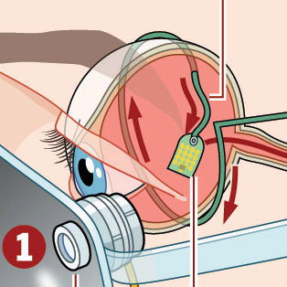5W - Retinal Implant